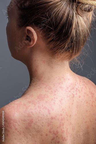 A woman with a red, spotty rash caused by measles.