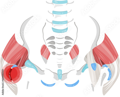 trochanteric bursitis