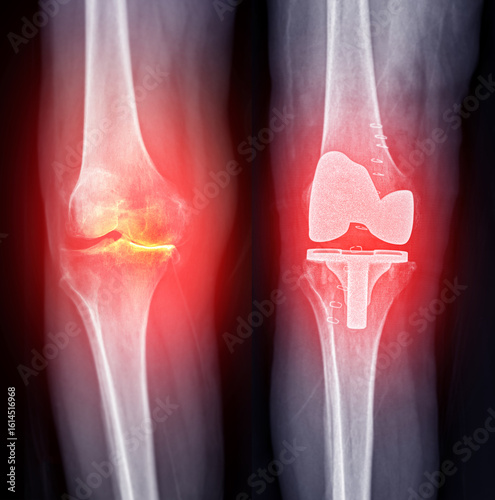 X-ray Comparison image showing preoperative knee degeneration and postoperative stability after total knee replacement surgery.