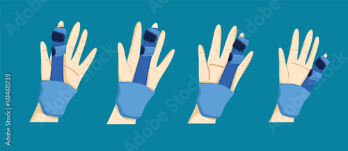 Broken Finger Treatment with Splint and Bandage in Medical Care

