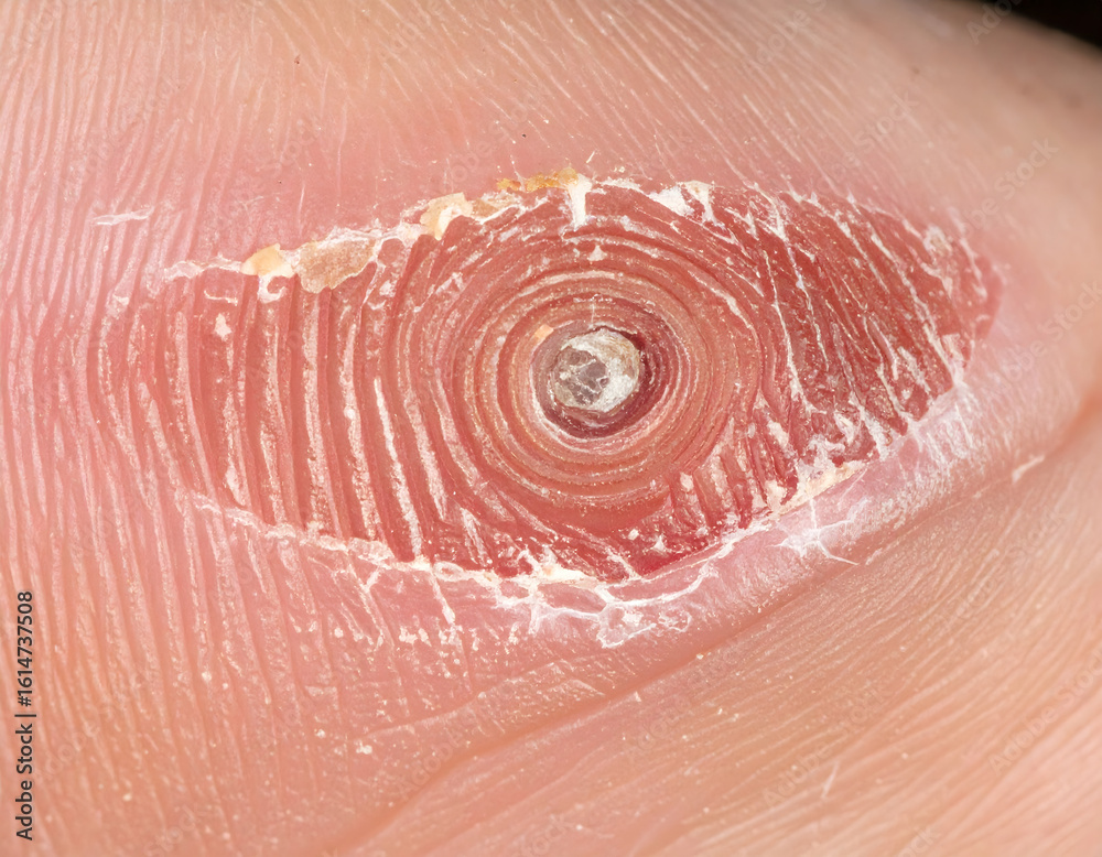 Fototapeta premium close-up of a human foot with a painful plantar corn, realistic medical photograph