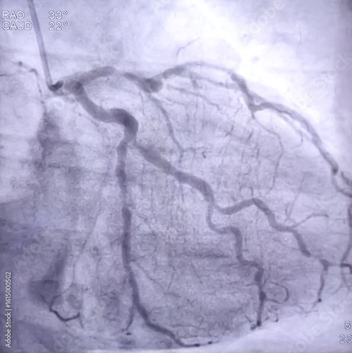 Coronary angiogram of left coronary artery during cardiac catheterization with contrast dye. Abnormal findings. Colour adjust.