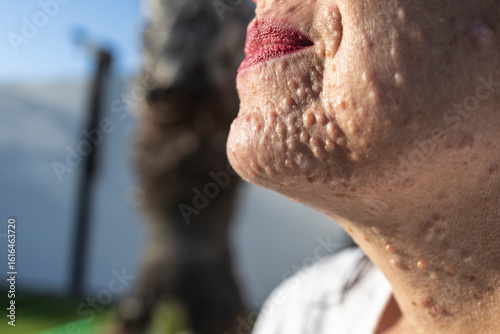 Chin of Female Patient with Neurofibromatosis