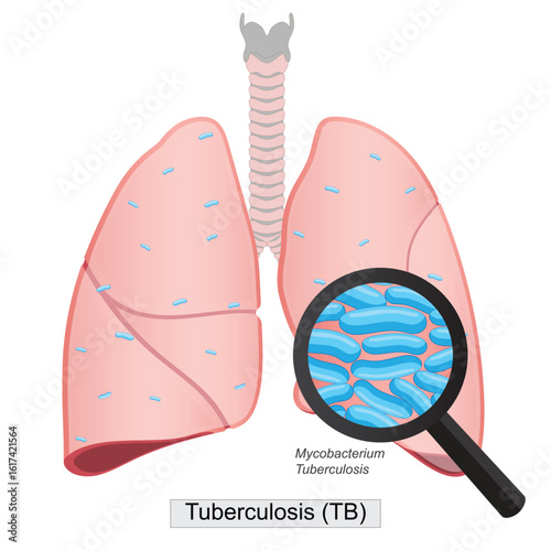 Tuberculosis also called TB is a serious illness that mainly affects the lungs.