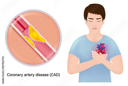 Coronary artery disease vector. Coronary heart disease. CAD that caused by atherosclerosis. Coronary artery stenosis. Clogged arteries caused by cholesterol.