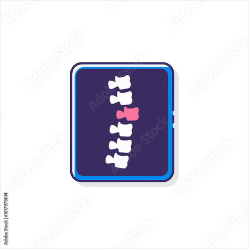 Spine xray showing a vertebral fracture in a medical setting, highlighting the injury with bright colors and clear detail, indicating a health issue.