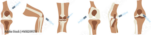 "Knee Injection Procedure Stock Illustration Bundle Set"
A detailed medical vector bundle showcasing step-by-step knee injection procedures. Ideal for healthcare presentations, educational materials, 