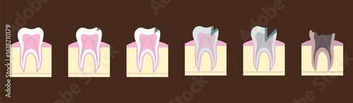 Vector illustration showing the process of carious destruction of a tooth for dental and educational use.