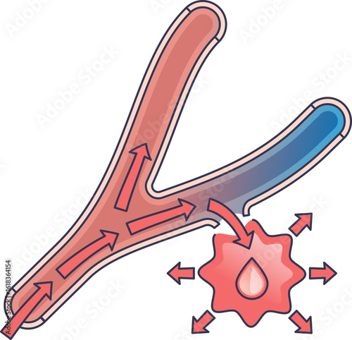Illustration of a hemorrhagic bleed, where blood escapes a ruptured vessel. Arrows show blood flow and extravasation. Main objects: blood vessel, leaking blood. Concept: internal bleeding.