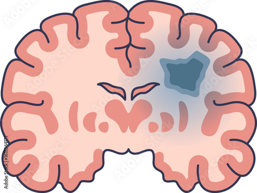 A medical illustration of a brain cross-section showing a hypoxic area. The blue region represents tissue damage from oxygen deprivation, as seen in a stroke or anoxic brain injury.