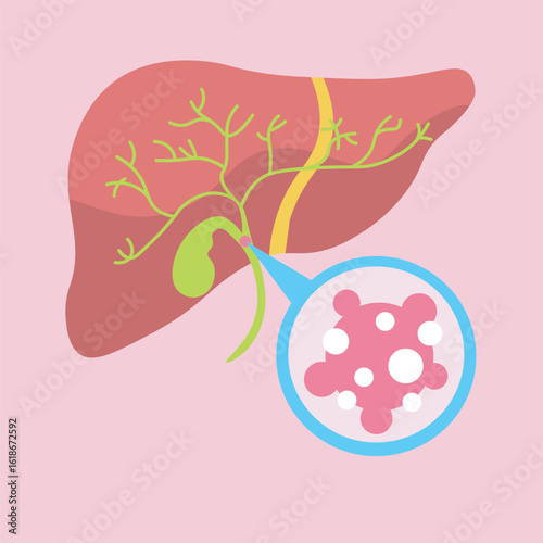 Minimalist vector illustration of bile duct cancer, showing key symptoms like jaundice, abdominal pain, and weight loss, with icons of similar diseases such as gallstones and hepatitis. liver 