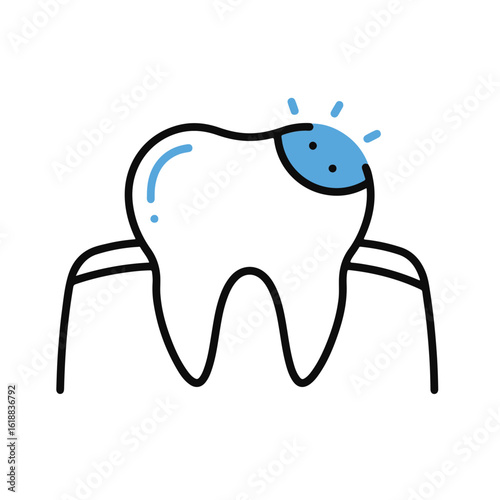 A molar illustration representing tooth decay or caries, showcasing a cavity.