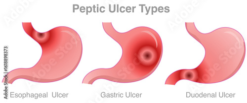 Peptic ulcer types. Stomach, esophageal, duodenal. Acid reflux, gastro diseases, digestive gastrointestinal cancer.. Vector illustration	