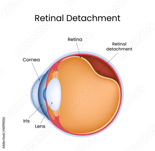 Retinal Detachment Illustration Eye Anatomy and Medical Condition