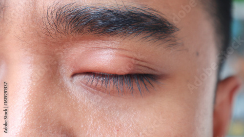 Schilderij op canvas Close-up of a human eye with a swollen eyelid, possibly indicating a stye or infection, highlighting a common eye health issue