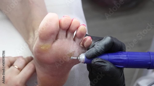 Treatment of foot skin defects with a special instrument.