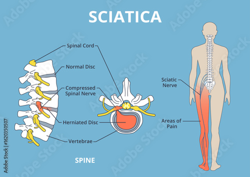 Sciatica pain scheme. Health care medical anatomical poster, vertebrae, spine and spinal cord, herniated disk, education banner design, human silhouette, nowaday vector anatomy infographics