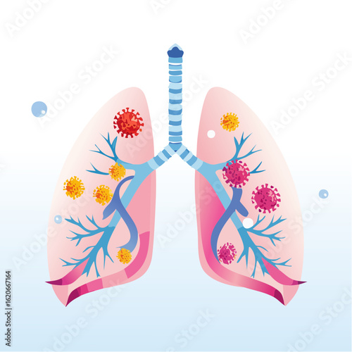 Anatomical illustration of a viral lung infection showing pathogens in the human respiratory system