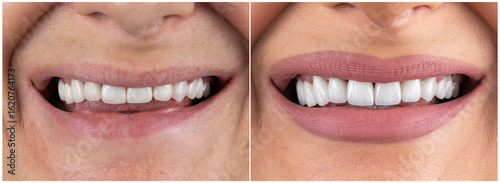 ceramic emax crowns and veneers bl4 color