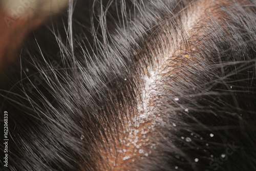 Billede på lærred Scalp close-up showing dandruff and hair texture