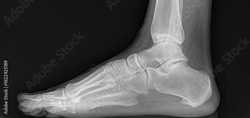 radiography of a foot with a clear example of a case of a heel spur.