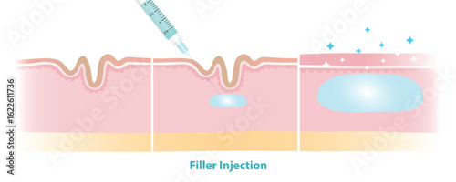 Filler injection procedure under the skin vector illustration. Dermal filler injected through the needle insertion to dermis skin layer for the treatment of facial aging. Medical and beauty concept.