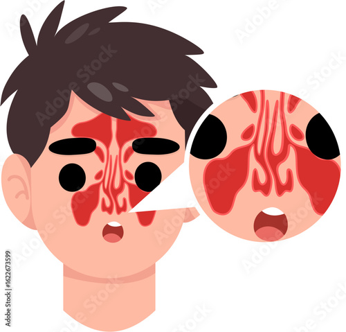 deviated nasal septum