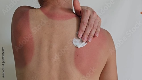 Tips for soothing sunburn and preventing skin damage after a day outdoors