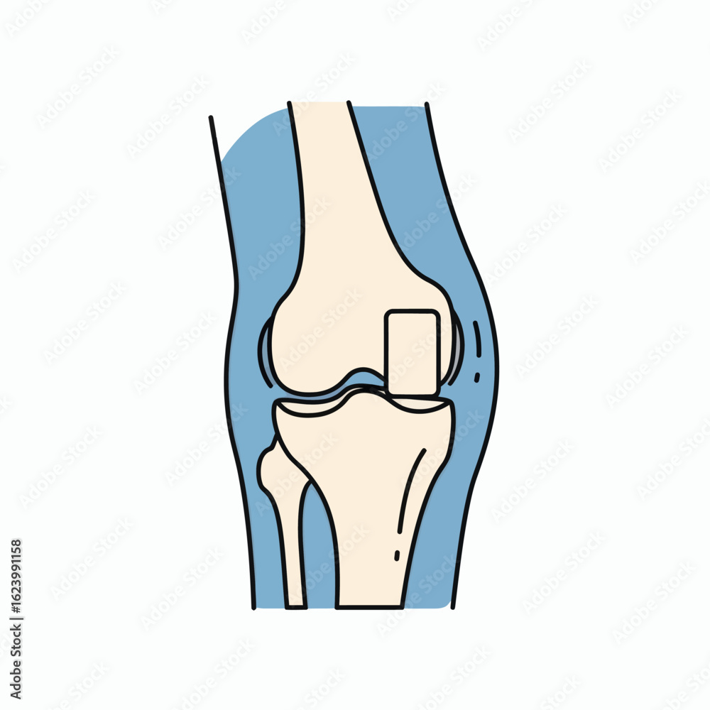 A knee joint illustration shows a stylized knee with a bonecolored femur tibia and a blue outline representing the soft tissue A knee joint illustration shows a stylized knee with a bonecolored femur tibia and a blue outline representing the soft tissue