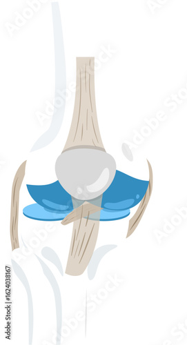 medial subluxation