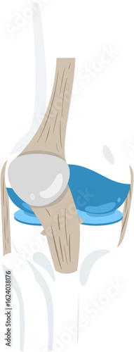 patellar subluxation