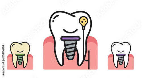 Dental Implant Graphic: A Simplified Illustration of Tooth Replacement and Oral Health Procedures