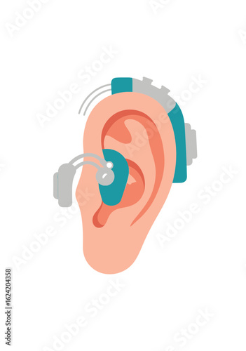 Modern cochlear implant hearing device fitted on a human ear a flat vector illustration.
