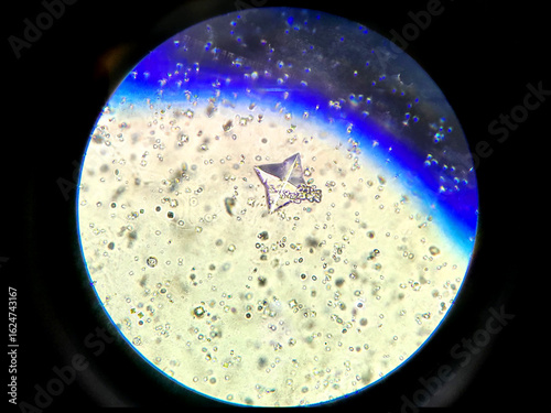 Tableau sur toile Urine Microscopy Showing Calcium Oxalate Crystals in High Magnification