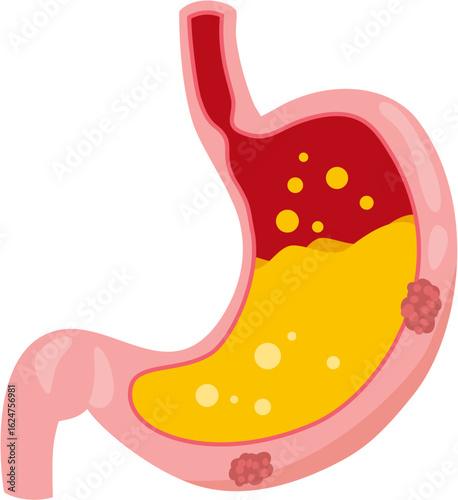 stomach cancer