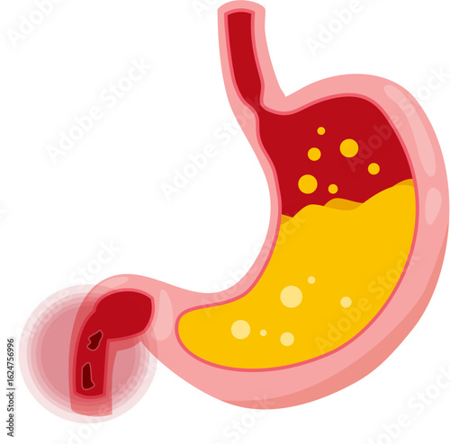 duodenal ulcer