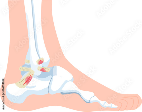 inversion ankle sprains grade 1