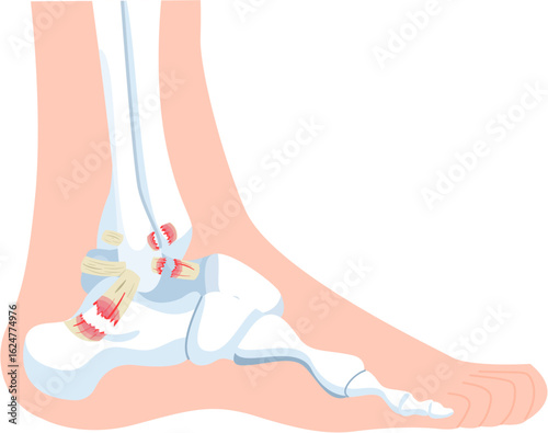 inversion ankle sprains grade 3