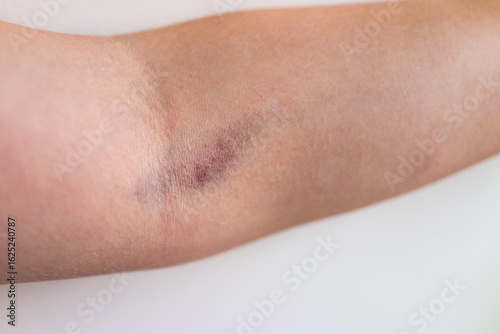 Wallpaper Mural Macro closeup of female woman arms with large bruise medical condition due to blood test or vaccine showing texture of skin and blood Torontodigital.ca