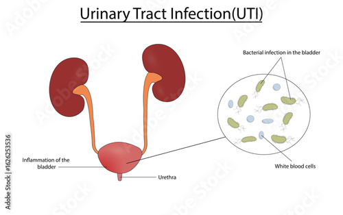 Urinary tract infection(UTI) vector illustration