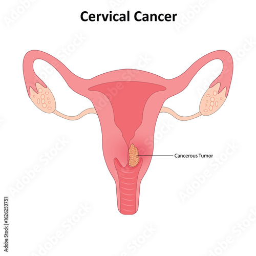 Cervical cancer vector illustration