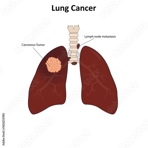 Lung cancer vector illustration