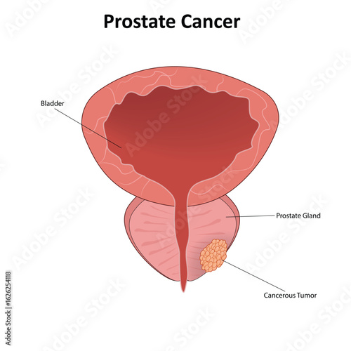Prostate cancer vector illustration