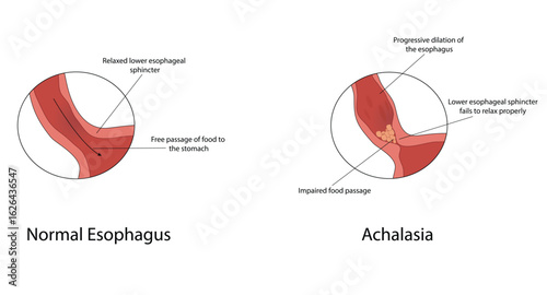 Achalasia vector illustration