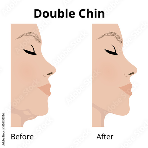 Woman face before and after double chin reduction