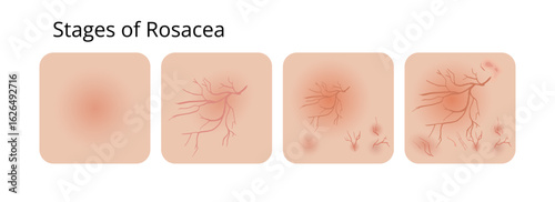 Rosacea skin condition showing different stages of its development