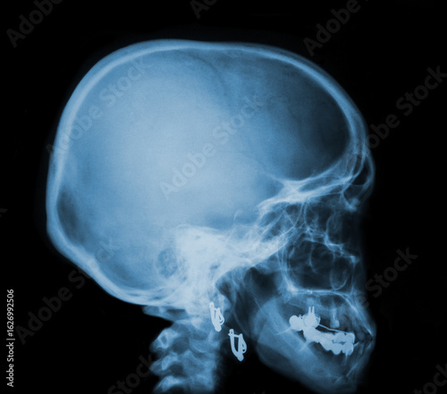 X-ray image of skull human. Medical examination, x-ray for medical diagnosis 