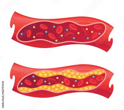 Types of cholesterol in human blood vessels. Normal and narrowed artery for explanation diseases. High-Density Lipoprotein HDL and Low-Density Lipoprotein LDL. Vector illustration