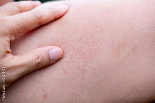 Vászonkép Close up of irritated human skin with red rash and inflammation, suitable for medical, dermatology, allergy, and skincare-related concepts in healthcare or pharmaceutical design
