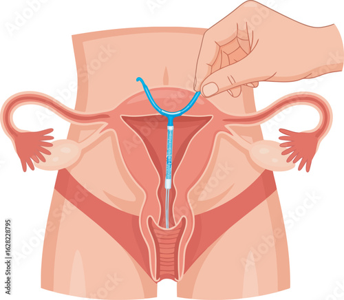 Anatomical vector illustration of a hand inserting a blue IUD contraceptive device into the uterus.